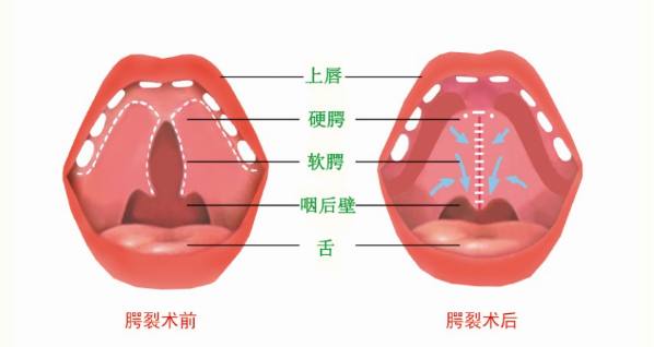 先天性腭裂